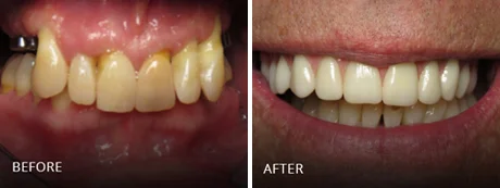 Corrected, aligned, and aesthetically enhanced upper smile.