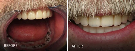 Finalized, bright upper and lower dental restoration.