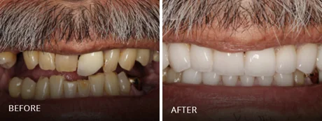 Uniform, straight, and bright white smile.